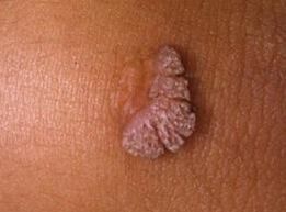 Le virus du papillome humain, qu'est-ce que c'est 